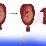 سرکلاژ یا دوختن دهانه رحم | دلیل و طریقه انجام آن